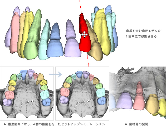 矯正歯科セットアップモデルシミュレーション